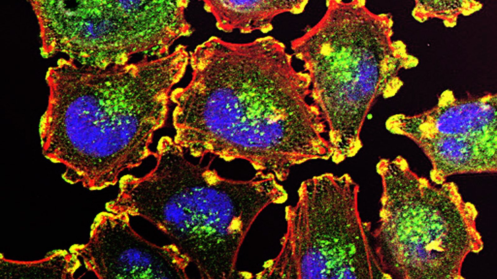 Fluorescence microscope image of melanoma cells with blue nuclei, red actin filaments and yellow podosome structures